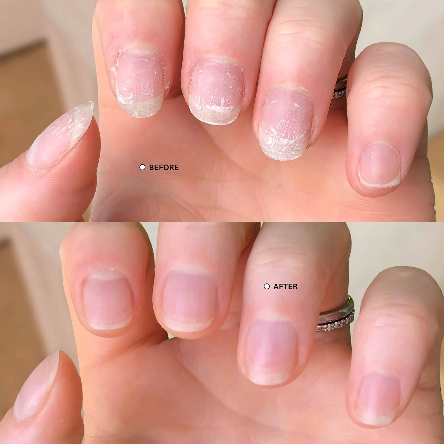 Nail Treatment